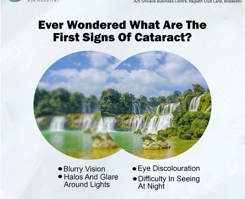 CATARACT