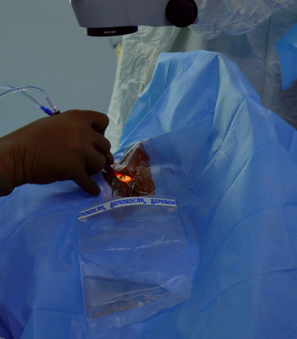 Photorefractive Keratectomy Surgery In Ahmedabad